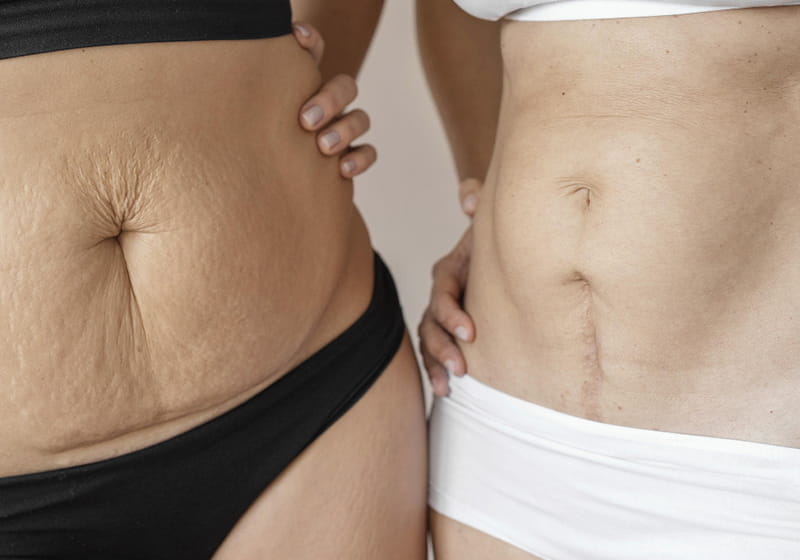 Stretch Mark